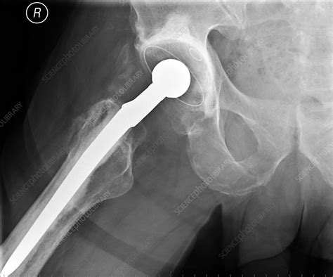 Total Hip Replacement X Ray Stock Image M6000401 Science Photo