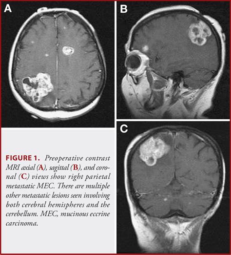 Figure 1 From Intracranial And Spinal Metastases From Eccrine Mucinous