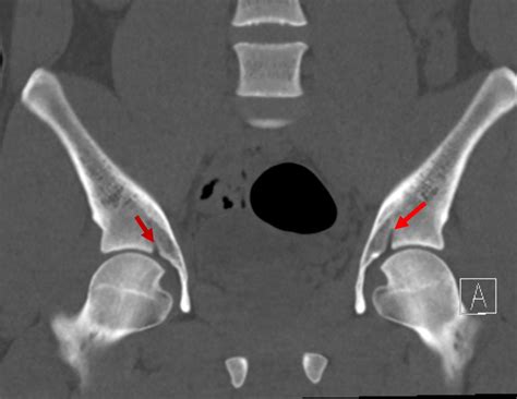 Sameer Raniga On Twitter A Superior Acetabular Roof Notch A Normal