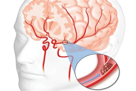 enfermedad cerebrovascular sus causas síntomas y mucho más
