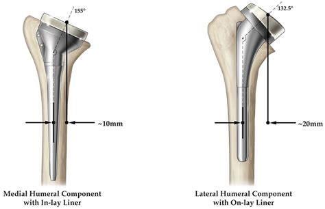 Jfmk Free Full Text Reverse Shoulder Arthroplasty Biomechanics