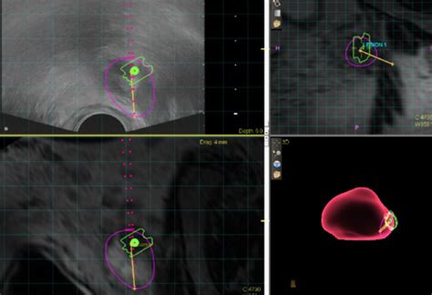 Magnetic Resonance Imagingultrasound Fusion Biopsy During Prostate Cancer Active Surveillance