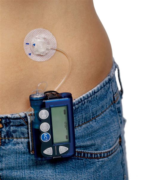 In cooperation with diabetes is a lifestyle changer. Advances in the Artificial Pancreas | diaTribe