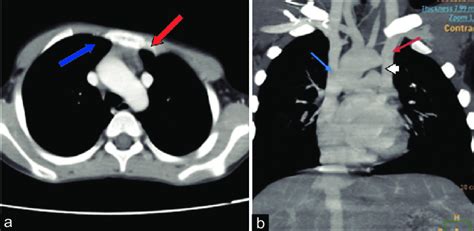 A Axial Postcontrast Computed Tomography Angiography Images Revealing