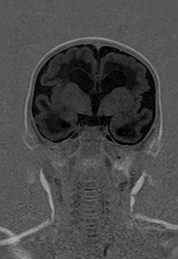 Congenital Cytomegalovirus Encephalitis Image