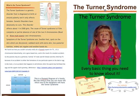 Media Turner Syndrome