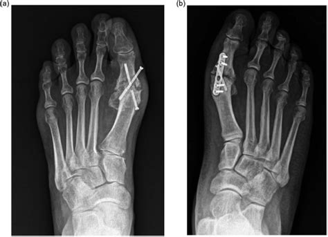 Incidence Of Nonunion Following First Metatarsophalangeal Joint