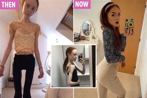 Scots Girls Hair Fell Out And Weight Plunged To Just 4st In Anorexia