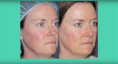 Ipl Photofacial San Diego Ca Cosmetic Laser Dermatology