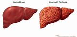 Poor Liver Health Symptoms