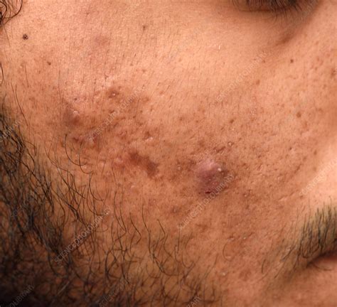 Cystic Lesions In Acne Stock Image C0372047 Science Photo Library