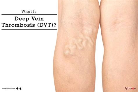 What Is Deep Vein Thrombosis Dvt Symptomstreatment And Prevention