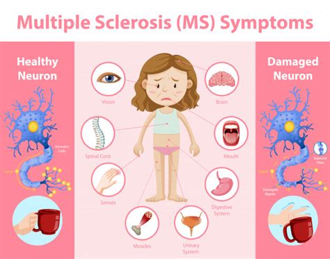 Multiple sclerosis is a chronic illness of the central nervous system. Free Vector | Multiple sclerosis (ms) symptoms information ...