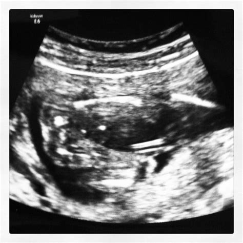 21 Weeks Pregnant Ultrasound
