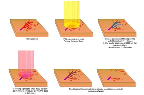 Lasers with pulsed dye, ktp, or pulsed lights for red laser. Traitement des rougeurs et de la couperose au laser à Metz