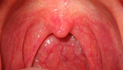 What Causes Acid Bumps On Tongue