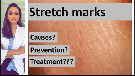 Stretch Marks Causes Prevention Treatment Dermatologist Dr