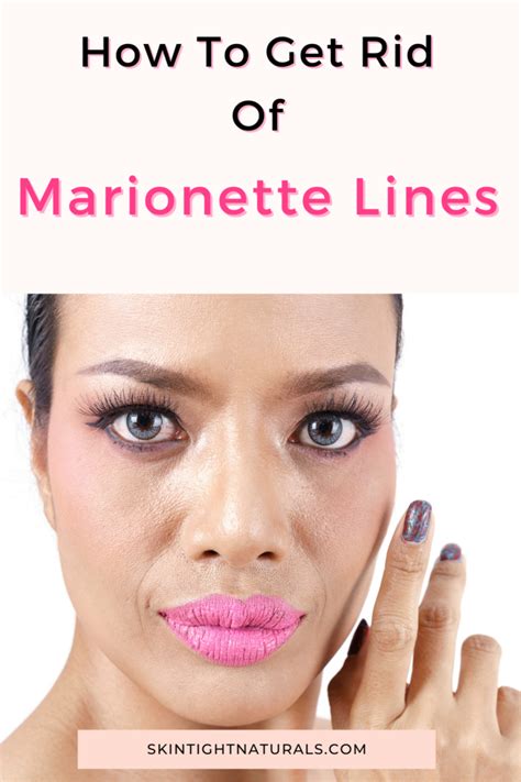 How To Get Rid Of Marionette Lines Skin Tight Naturals