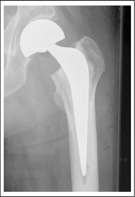 Figure 1 From Undersizing The Exeter Stem In Hip Hemiarthroplasty