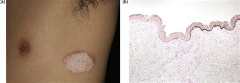 Vitiligo Onset Removes Congenital Nevocellular Nevus Cells
