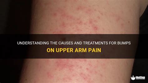 Understanding The Causes And Treatments For Bumps On Upper Arm Pain