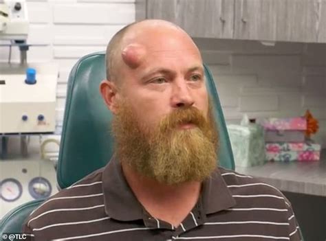 Dr Pimple Popper Squeezes Cheesy Warm Grits Out Of A Mans Golf Ball Shaped Head Cyst Daily