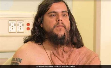 Rare Skin Disease Left Him Isolated Surgery Gave Him Back