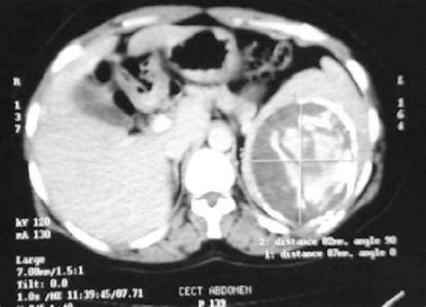 Ct Scan Showing Hydatid Cyst In Spleen Download Scientific Diagram