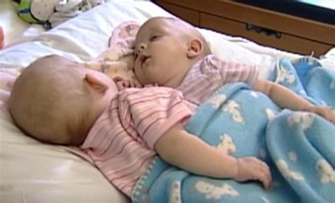 14 Years Ago Surgeons Separated Conjoined Twins How They Live Now