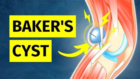 What To Do About Baker S Cyst Treatment In 2024 Youtube