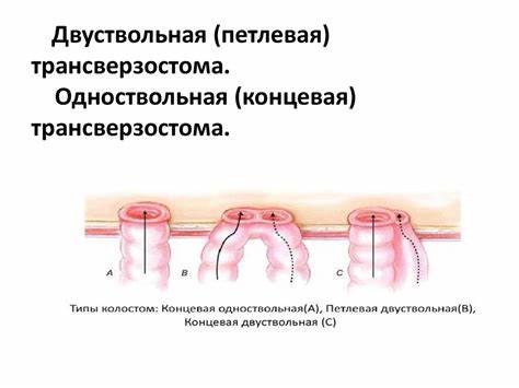 Колостома какая диета Колостомия. Анатомо-физиологические особенности кишечного пищеварения Колостомия. Анатомо-физиологические особенности кишечного пищеварения Колостома какая диета