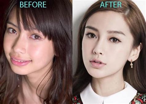 Hong Kong Celebrity Plastic Surgery Before After