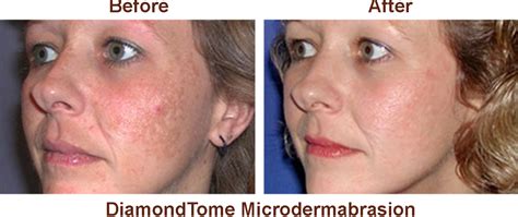 Orange County Microdermabrasion Skin Treatment At Amoderm Irvine