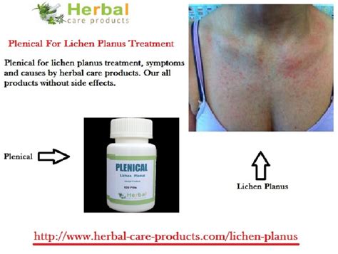 Natural Treatment Of Lichen Planus Effect In Hair Loss By Jennifer