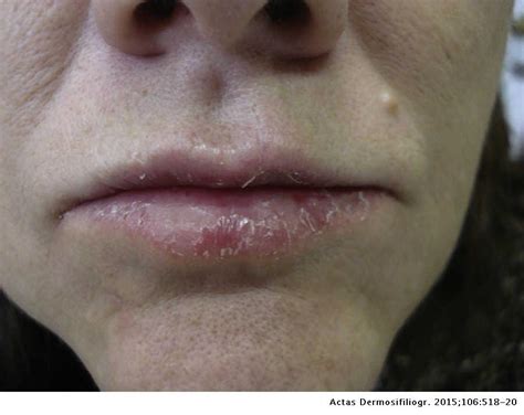 Photoallergic Contact Dermatitis Due To Chlorpromazine A Report Of 2