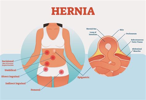 Are Hernias Common After A C Section