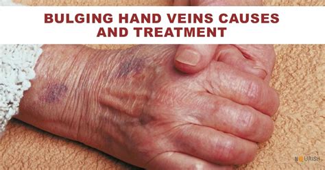Bulging Hand Veins Causes And Treatment Nourishdoc
