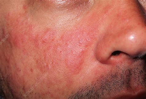 lupus skin rash stock image m200 0168 science photo library