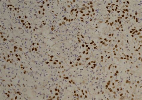 The results were compared with the standard laboratory panel for mesothelioma diagnosis: Malignant deciduoid mesothelioma: a rare variant of ...