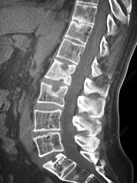 Ankylosing Spondylitis Spine Ct Scan Stock Image C021