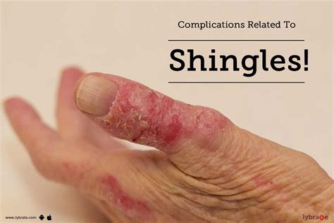 complications related to shingles by dr sushma yadav lybrate