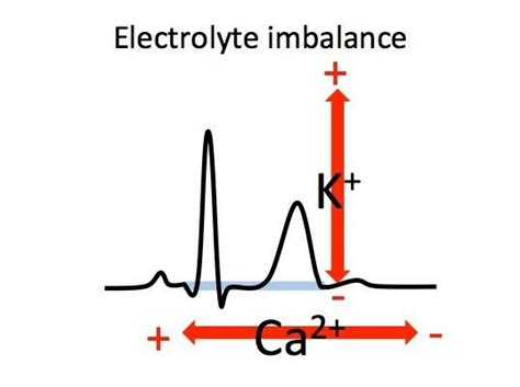 Electrolyte Imbalances EKG Emergency Nursing Medical Babe Studying Nursing Babe Survival