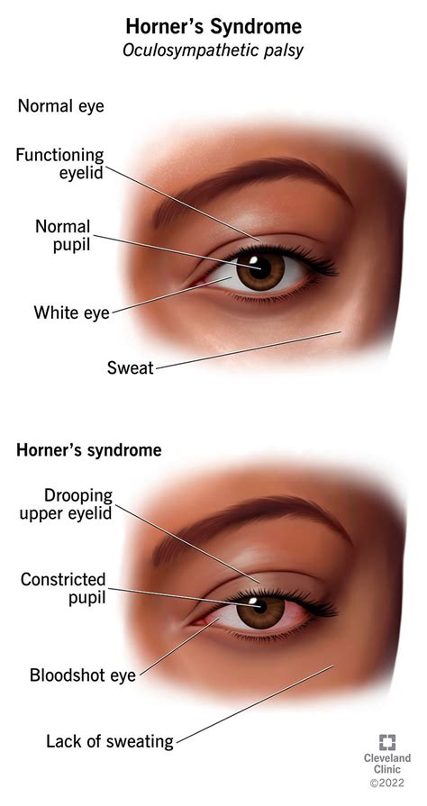 Horner Syndrome What It Is Causes Symptoms And Treatment