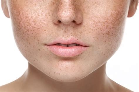 What Is Pigmentation Skinsmart Dermatologist Recommended Skincare