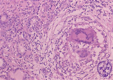 Thyroiditis refers to a group of disorders that cause inflammation of the thyroid. 13.Endocrine (3) Subacute thyroiditis|Pathology Core Pictures