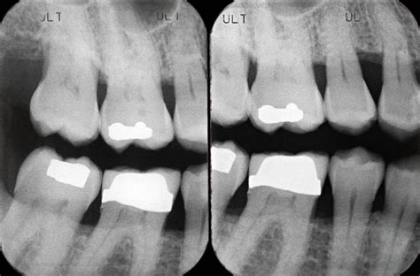 Radiographic Caries Detection Is Highly Accurate