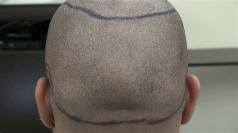 Black Fue Hair Transplant Scar By Dr Diep 1 Year After Bald Hair Loss