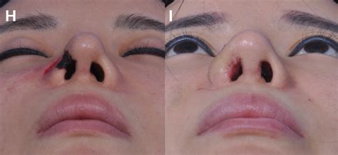 Symptoms And Treatment Of Necrosis Of The Nose After Filler Injection