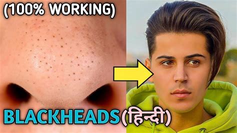How To Remove Blackheads From Face At Home100 Working Remove Black Spots From Facestyle