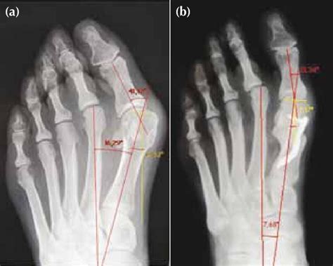 Hallux Valgus Foot Ankle Orthobullets Vlr Eng Br